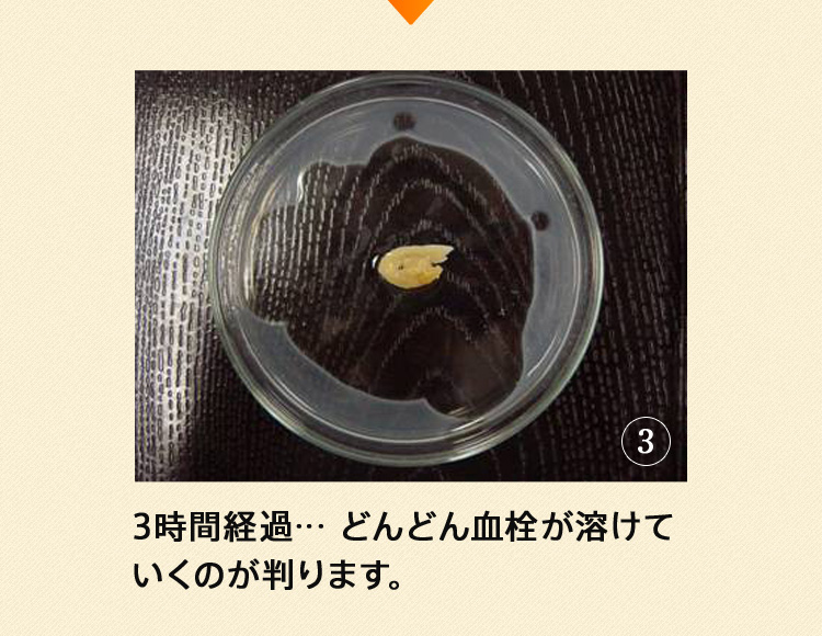 3時間経過…どんどん血栓が溶けていくのが判ります。